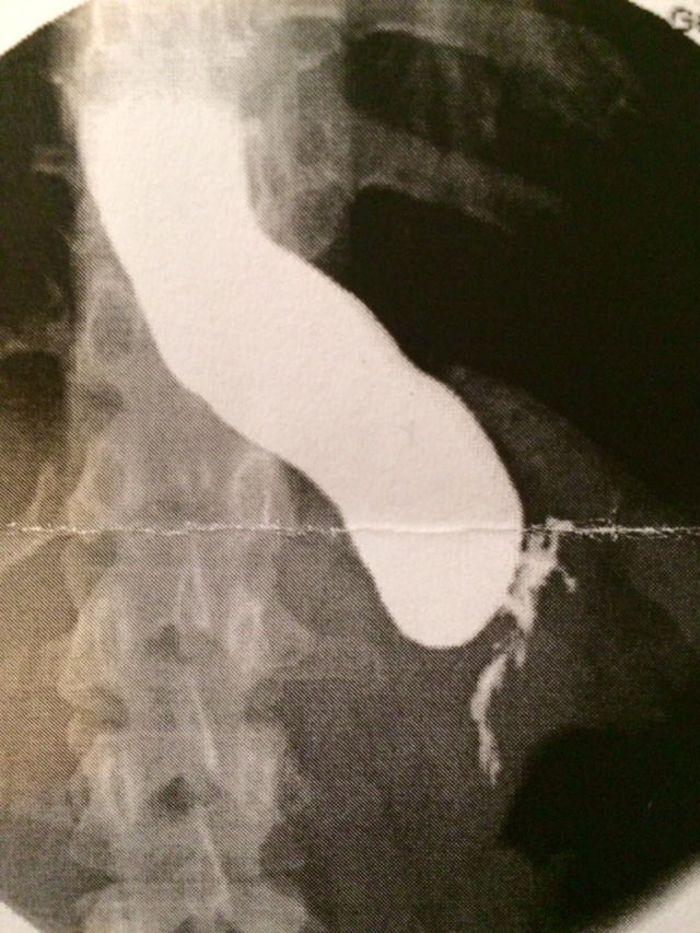 Barium Swallow Post-Surgery
